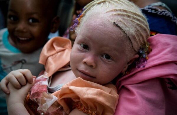 Problems with Albinism