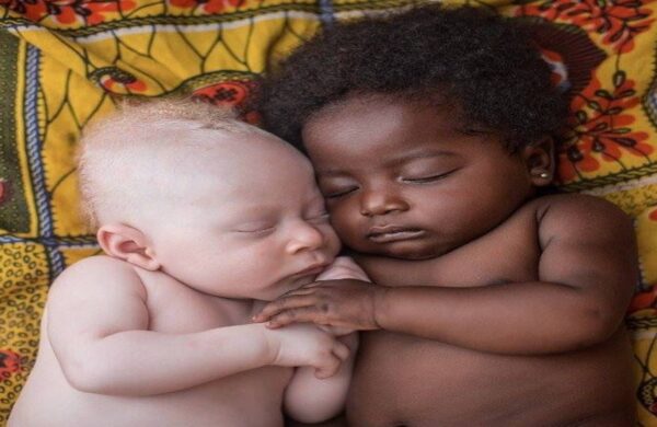 Helping children with albinism