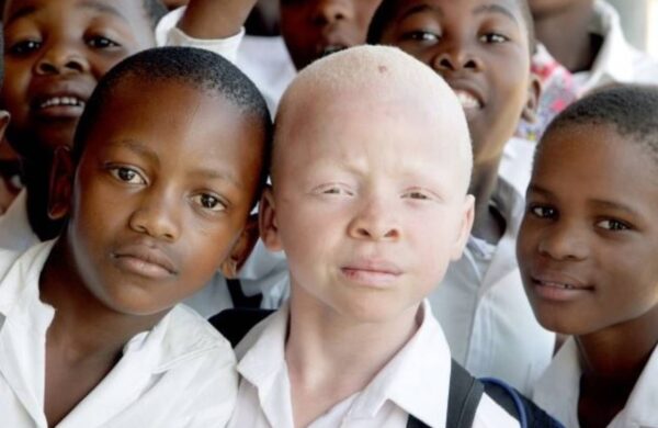 Save Albinism